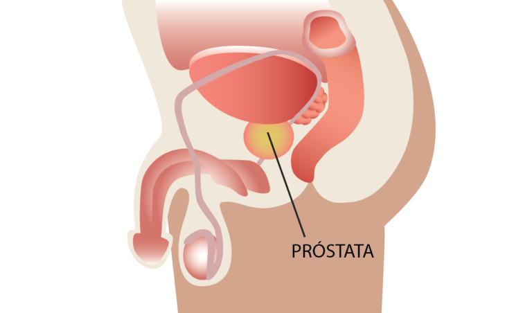 Adenoma de próstata